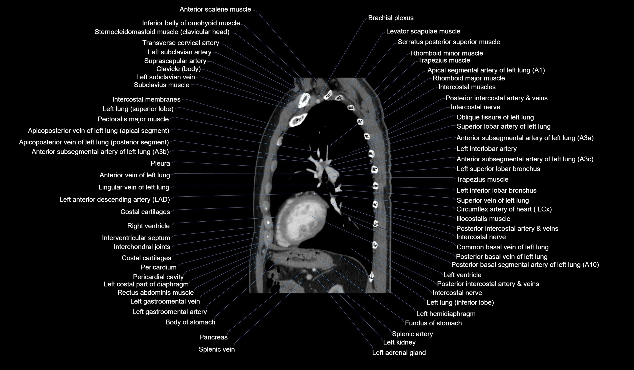 CT chest (thorax) soft tissue window labelled sagittal cross sectional anatomy radiology image-00093.webp